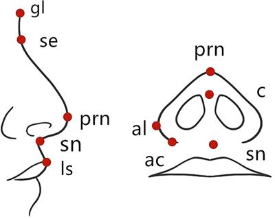 Morphological Analysis of Nose in Patients of Tessier No. 0 Cleft With a Bifid Nose in China